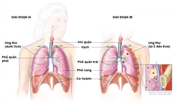 Ung thư phổi giai đoạn I
